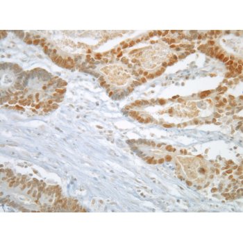 Immunohistochemistry staining of the Mad2L1 antigen in colon cancer using IQ239 antibody.  Tissues were formalin-fixed and paraffin-embedded. Antibody was used at 1/200 dilution for 1hour at room temperature  following antigen retrieval with Tris-EDTA pH9