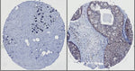 IHC staining of Formalin/PFA-fixed paraffin-embedded sections using the Anti-HEF1 antibody [2G9]. Normal breast tissue is shown on the left, and ductal carcinoma on the right. The antibody was used at 1/100, diluted in TBS with 0.1% Tween20 and 3% BSA, with o/night incubation.