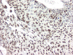 Immunohistochemistry - Anti hnRNP A2B1 Antibody [DP3B3] on lung tissue sections showing squamous cell carcinoma