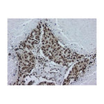 Immunohistochemistry - Anti  hnRNP A2B1 Antibody [DP3B3] on lung tissue sections showing squamous cell carcinoma