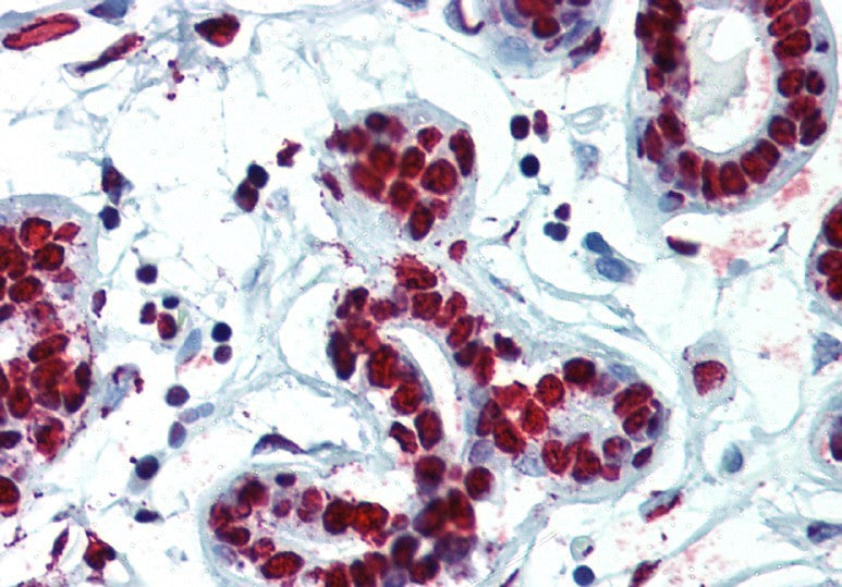 IHC using  hnRNP C1+C2 Antibody (IQ214) on Human breast