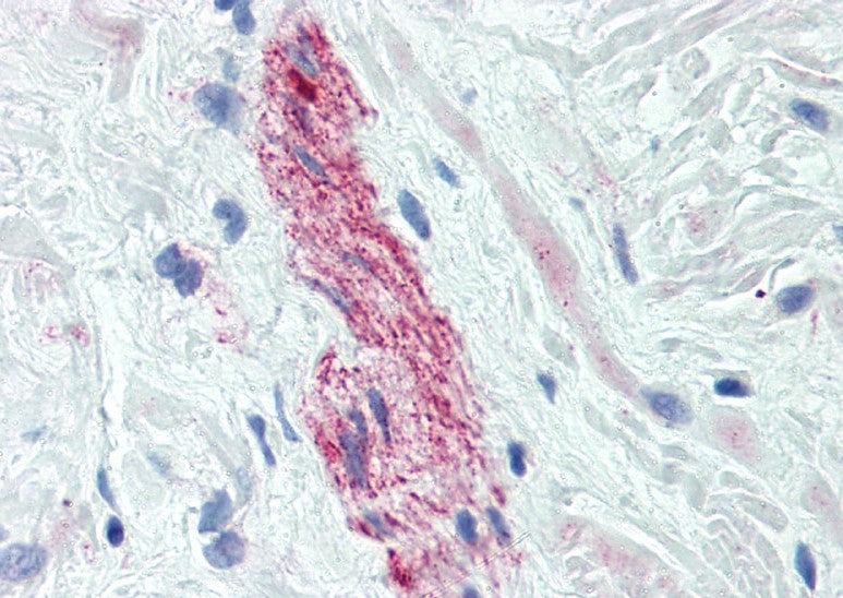 Immunohistochemistry of Anti-Nestin [10C2] antibody, showing staining of xenografted Human Glioblastoma tumor cells on formalin fixed paraffin embedded tissue